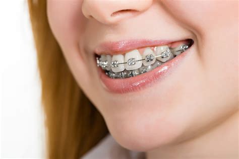 Más de 80 fotos de Brackets Metalicos y Metal gratis 